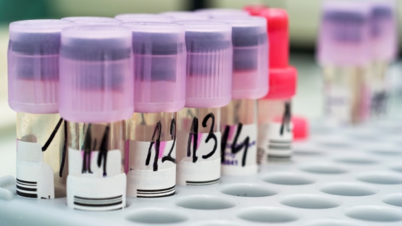 SR (sänka) – vad betyder provsvaret?